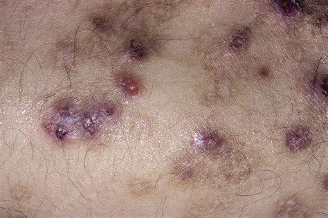 Prurigo lesions - Stock Image - C054/6397 - Science Photo Library