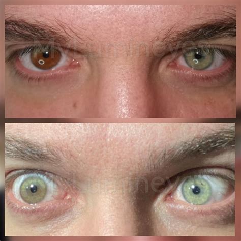 Lumineyes eye color change surgery — Turkey Eye Color Change Surgery ...