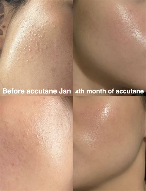 Comedonal Acne Before And After