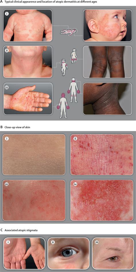 Atopic Dermatitis