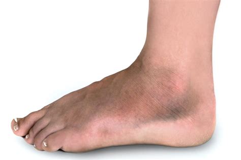 Broken ankle - NHS