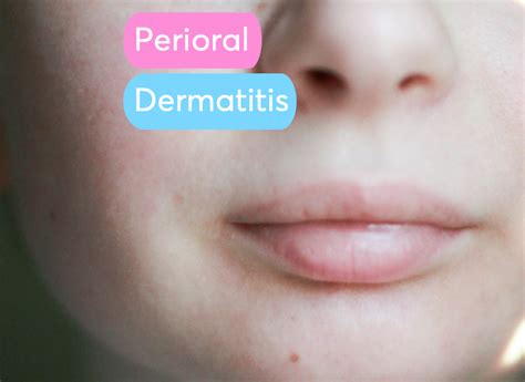 Perioral Dermatitis Chin