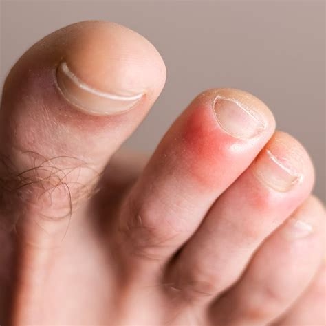 chilblains burchells feet