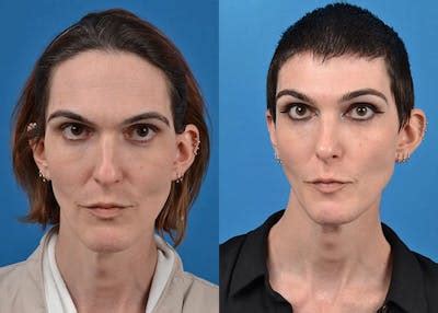 Facial Feminization Before & After Photos | Clevens Face and Body ...