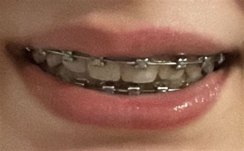 Braces | Зубные брекеты, Брекеты, Зубы