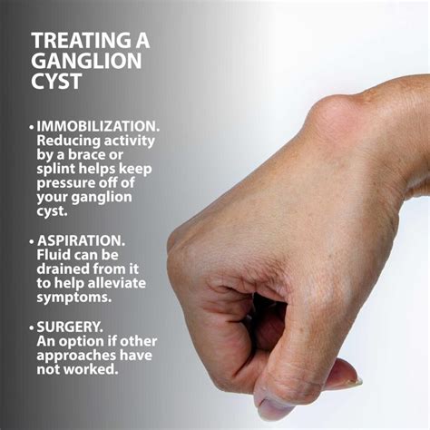 understanding ganglion cysts  symptoms  treatment