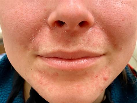 Skin Rash On Mouth Corner - Infoupdate.org