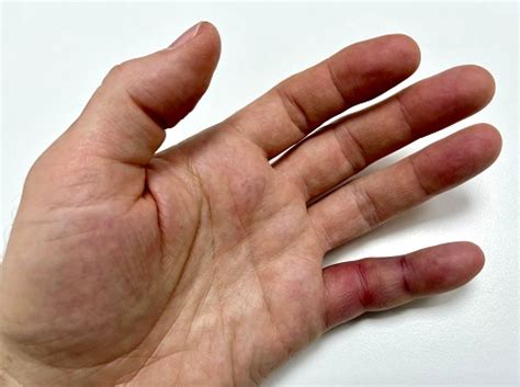 broken finger stock photo  image  bruise finger bone