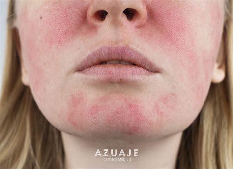 es la rosacea centro medico azuaje
