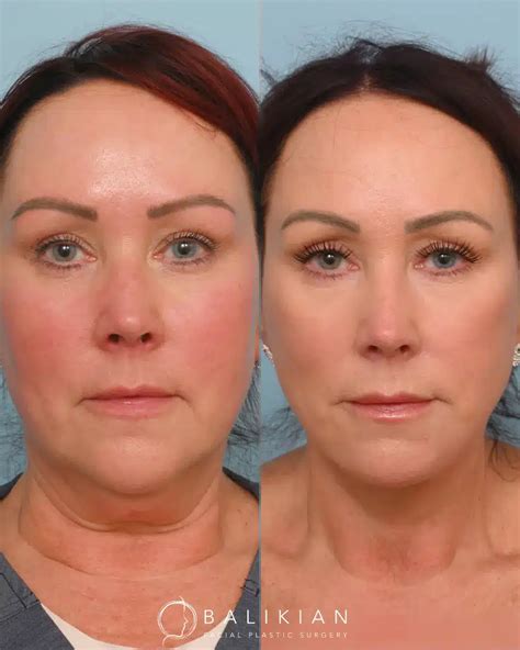 smas facelift techniques  variations
