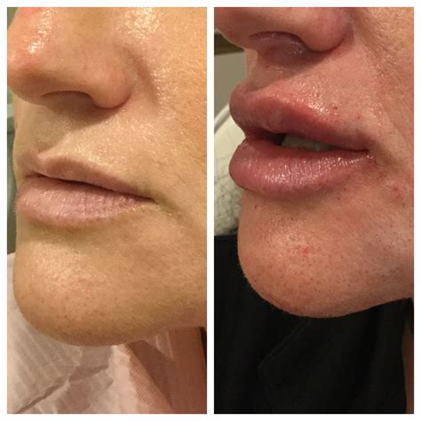 Chin Botox: Dramatic Before & After Transformations – Cost, Results