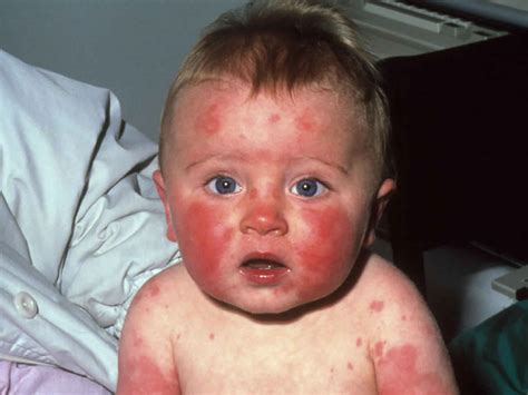 Erythema infectiosum causes, symptoms, diagnosis, treatment & prognosis