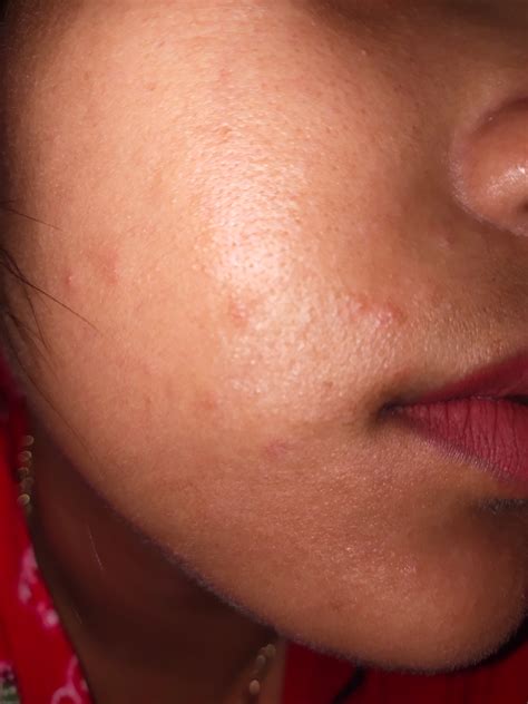 gatal  kulit wajah hellosehat