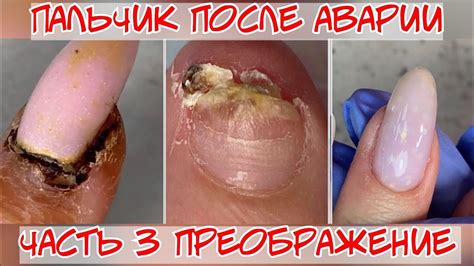 Преображение 3 ️ Восстановление ногтя после травмы 🔥 Финал 🔥 ...