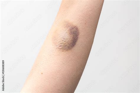 bruise  female arm stock photo adobe stock