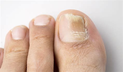 Matriz de unhas (18 fotos): o que é isso? Como tratar a área danificada?