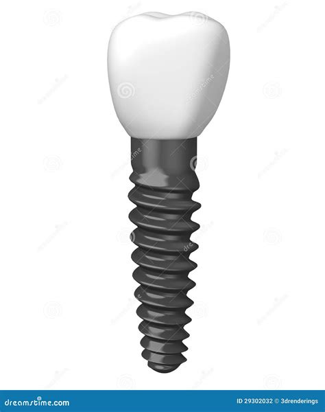 Single tooth implant stock illustration. Illustration of teeth - 29302032