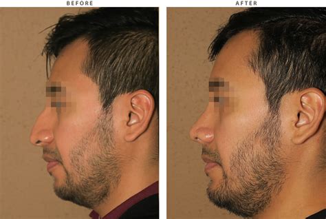 Rhinoplasty – Before and After Pictures * | Dr Turowski - Plastic Surgery Chicago