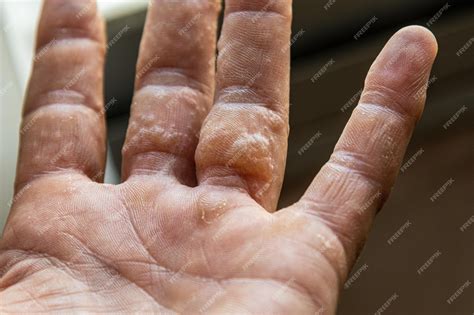 Premium Photo | Rash on fingers dyshidrotic eczema