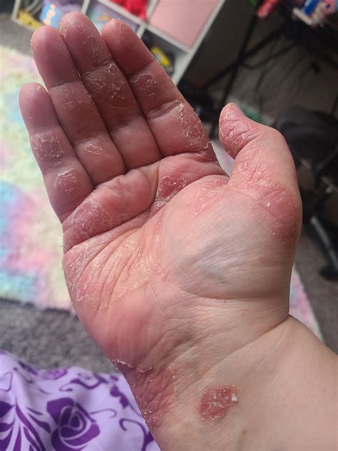 Recently diagnosed with a different skin disease : Psoriasis