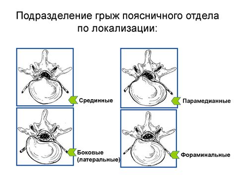 Грыжа диска L4: причины, симптомы, лечение