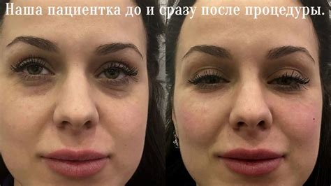Филлер от синяков под глазами фото до и после