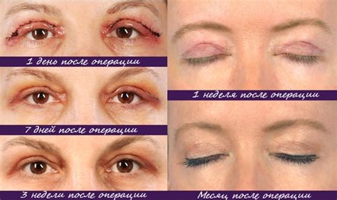Блефаропластика верхних век реабилитация по дням фото