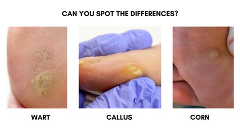 corn  callus  wart darwin podiatry