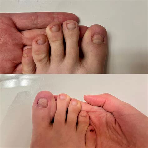 Finally got myself to try a laser treatment. 15 years of toe nail