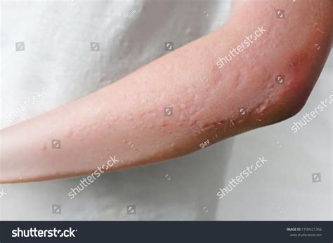 Skin Rashes Allergies Contact Dermatitis Allergic Stock Photo ...