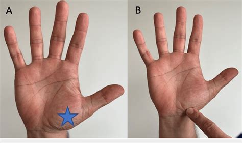 First carpometacarpal joint (A) Location of the first carpometacarpal... | Download Scientific ...