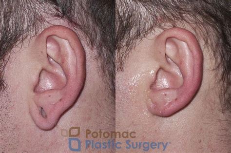 Cauliflower Ear Surgery
