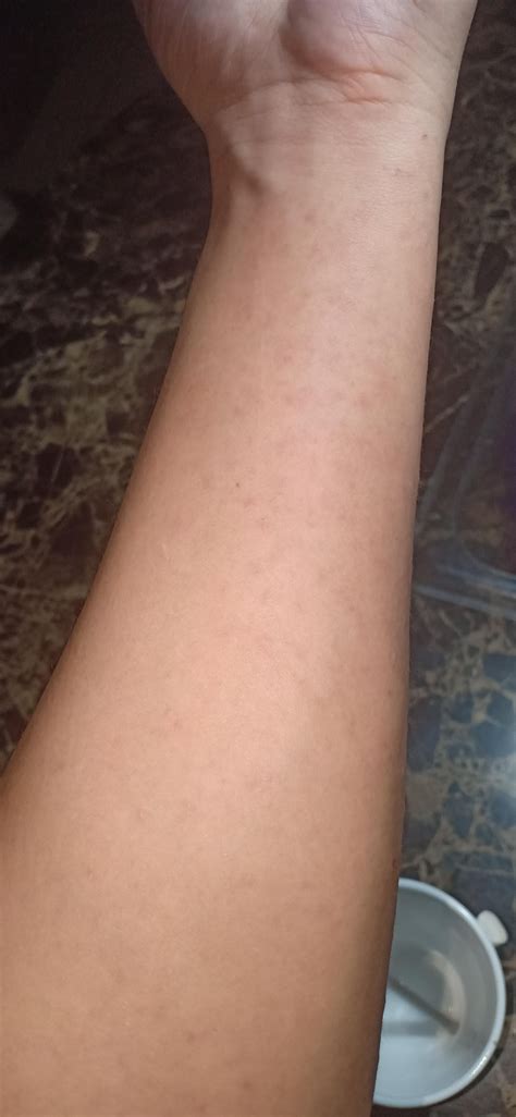 Can anyone confirm if this is scabies? : r/scabies