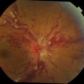 mild tortuous retinal vessels   left eye  scientific