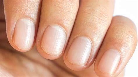 Nail Pitting: What Causes It & How You Can Treat It