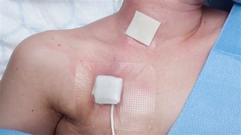 care   central venous catheter youtube