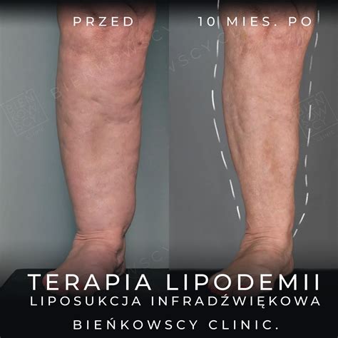 Lipodemia - obrzęk lipidowy i obrzęk tłuszczowy | Objawy i leczenie