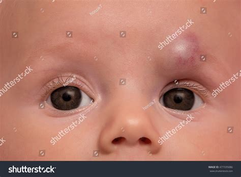 Infant Hemangioma On Forehead Baby Girl Stock Photo 477335086 ...