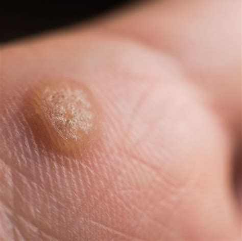 warts     ignore charlotte skin  laser