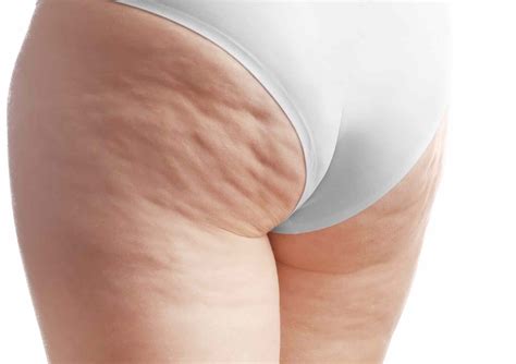 The Ultimate Guide to Get Rid of Cellulite Naturally — Moody Sisters