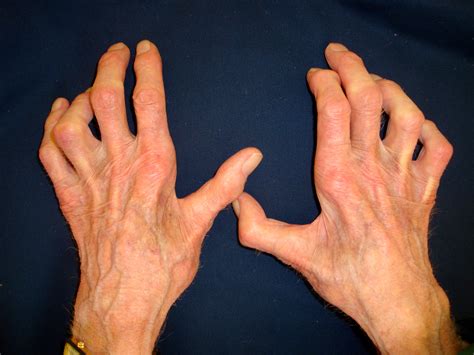 Ulnar Nerve Entrapment