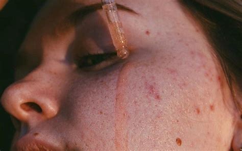 effective home remedies  erasing burn marks