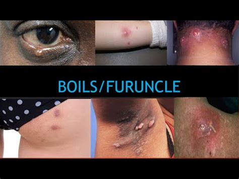 #boils 7 Facts about Boils - YouTube