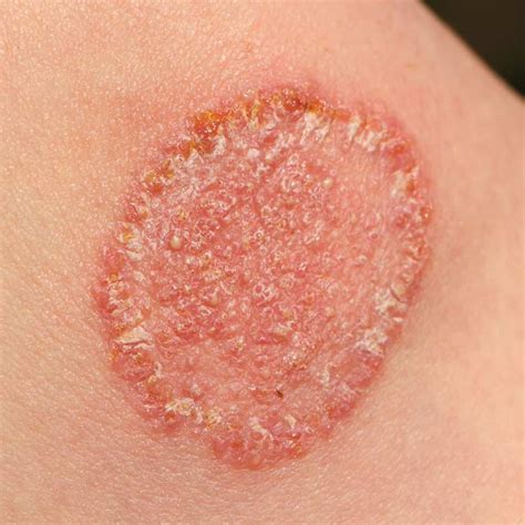 Prevention Of Fungal Infections - vrogue.co