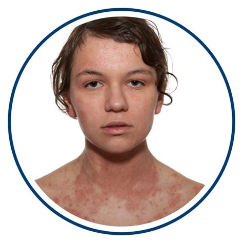 What is Eczema | Eczema Association of Australasia