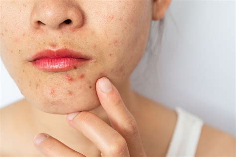 Acne Homeopathic Medication - Maira Sharif