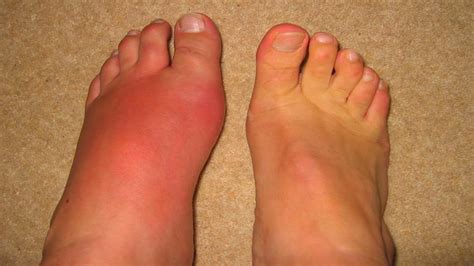 Gout in Pictures - Experiments on Battling Gout
