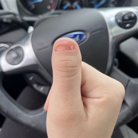 Has any one here lost their entire thumb nail and grown it back? I’ve