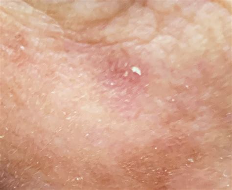 Actinic Keratosis: Put Your Finger on the Problem!