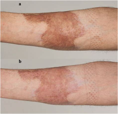 The use of carbon dioxide and intense pulsed light laser for the ...